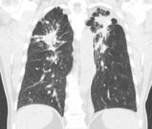 Black lung 